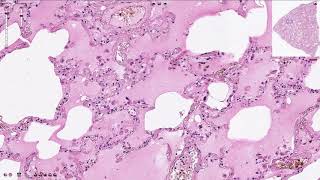 Pulmonary Edema  Histopathology [upl. by Retnyw]