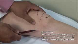 Knee Injection  Medial Approach [upl. by Ditter300]