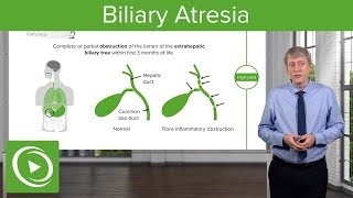 Biliary dyskinesia Medical Condition [upl. by Ellerud593]