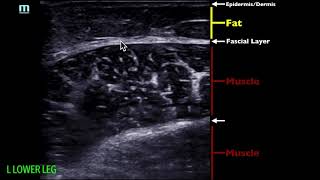 POCUS  Soft Tissue Ultrasound  Soft Tissue Edema [upl. by Sundstrom597]