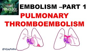 EMBOLISM Part 1 Pulmonary amp Systemic thromboembolism [upl. by Tiemroth620]