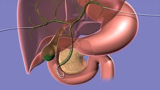 Introduction to Biliary Ultrasound [upl. by Kindig]