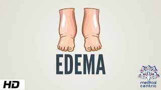 Edema Causes Signs and Symptoms Diagnosis and Treatment [upl. by Arvie606]