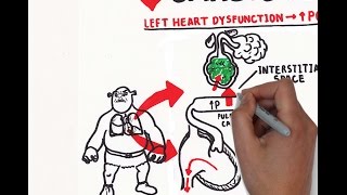 Pulmonary edema USMLE step 1 [upl. by Etta]