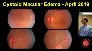 Cystoid Macular Edema [upl. by Standford397]